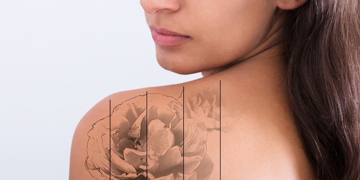 Top-Tattoo-Removal